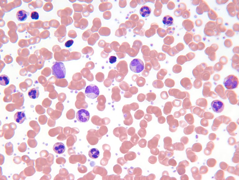cellule killer, globuli bianchi, linfoma Hodgkin, malattia Hodgkin