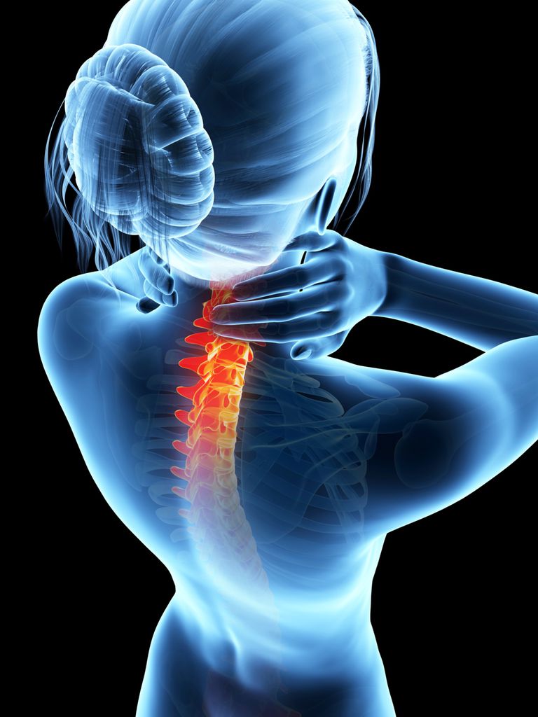 Artrite reumatoide, colonna vertebrale, della colonna, della colonna vertebrale, midollo spinale