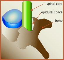 midollo spinale, iniezioni epidurali, alla schiena, anestetico locale, colonna vertebrale