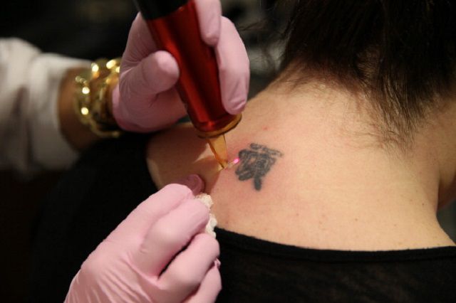 rimozione tatuaggio, tatuaggio laser, rimozione tatuaggio laser, sulla rimozione, sulla rimozione tatuaggio, altri metodi