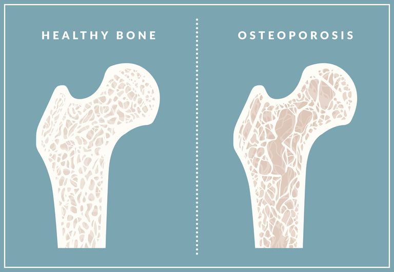 dell osteoporosi, alla mascella, altre opzioni, altre opzioni trattamento, classe farmaci