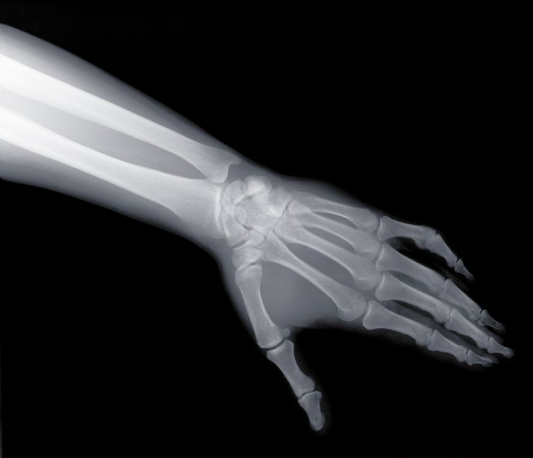 ossa carpali, tunnel carpale, della mano, dell articolazione, dislocazione perilunata, piccole ossa