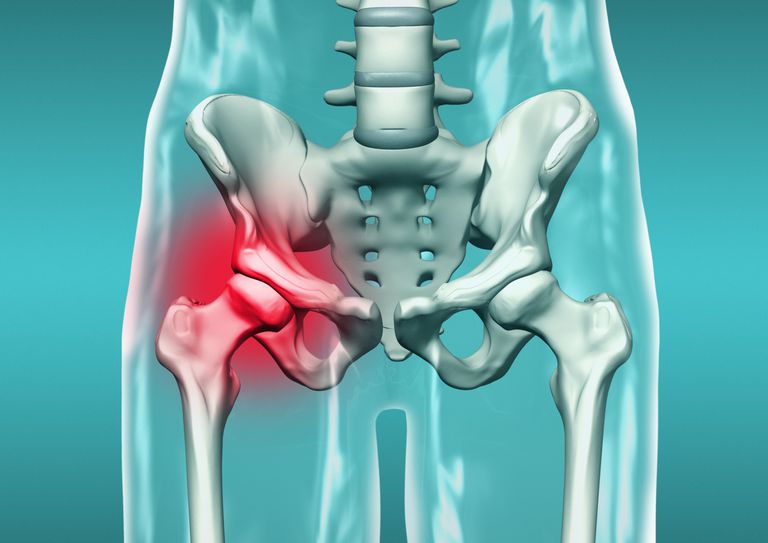dell anca, articolazione dell, articolazione dell anca, dell articolazione, dell articolazione dell, frattura acetabolare