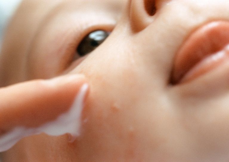 acne neonatale, dell acne, acne essere, acne infantile
