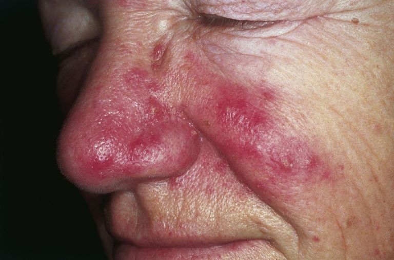 della pelle, cheratosi pilaris, area della, dell acne, follicolo pilifero