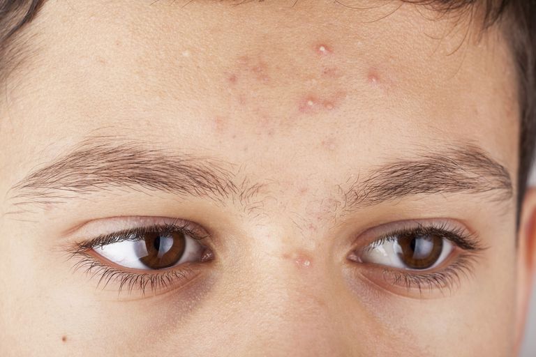 dell acne, modo diverso, pustole sono, della pelle