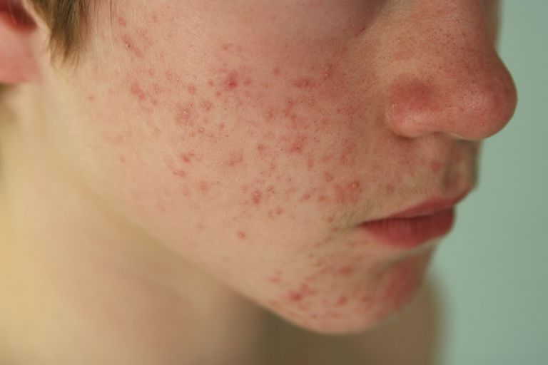 perossido benzoile, acne solito, maggior parte, vedere dermatologo, acne cistica