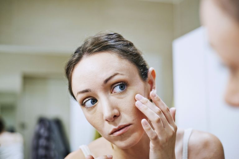 dell acne, della pelle, acne adulta, acne acne, acne Cosa, acne influisce