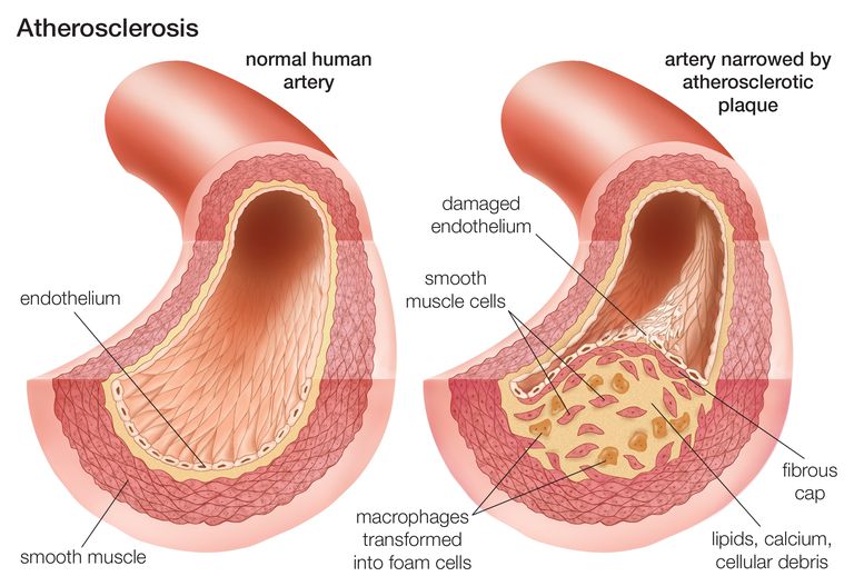 delle arterie, placche possono, aneurisma aortico, arteria causando, arterie periferiche, dell arteria