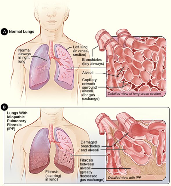fibrosi polmonare, fibrosi polmonare idiopatica, polmonare idiopatica, delle persone, negli Stati