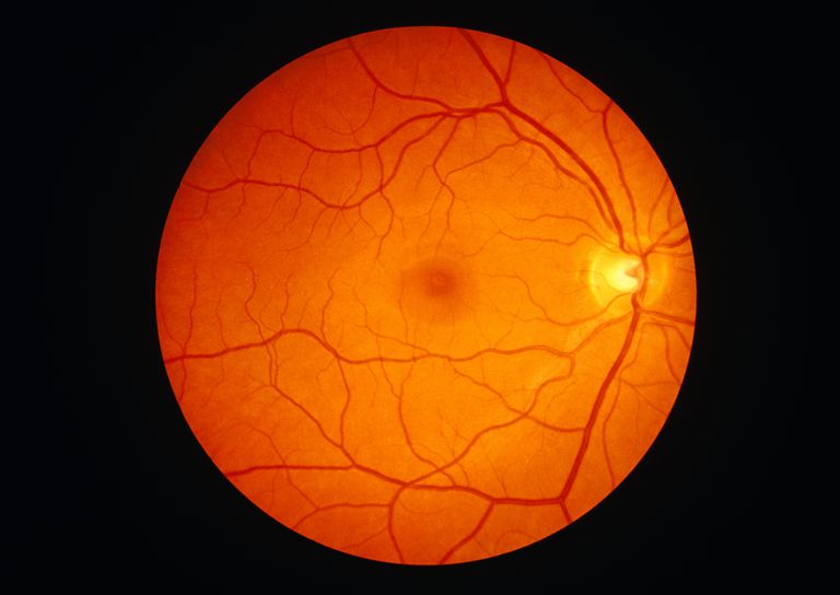 della retina, nervo ottico, dell occhio, distacco della