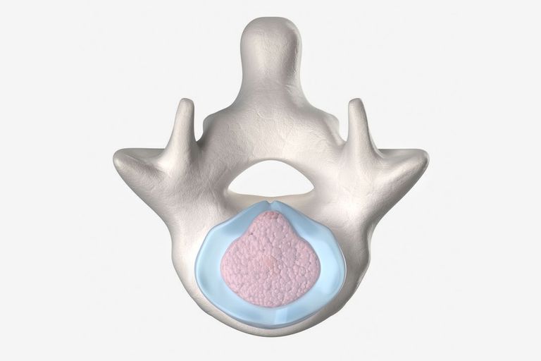 fessura anulare, della colonna, risonanza magnetica, colonna vertebrale, della colonna vertebrale, dischi intervertebrali