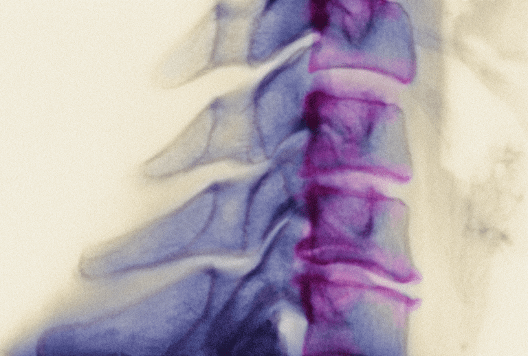 artrite collo, spondilosi cervicale, canale spinale, midollo spinale