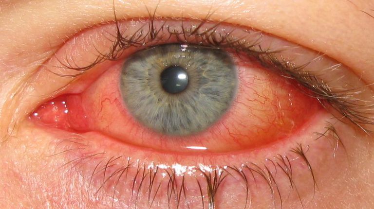 dell occhio, dermatite atopica, agli occhi, allergica sebbene, congiuntivite allergica, congiuntivite allergica sebbene