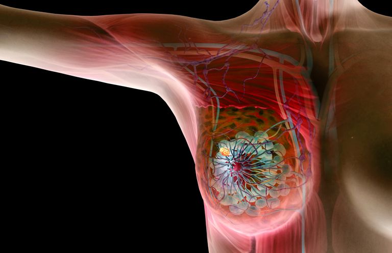 cancro seno, cisti seno, Nozioni base, possono essere, vicino alla