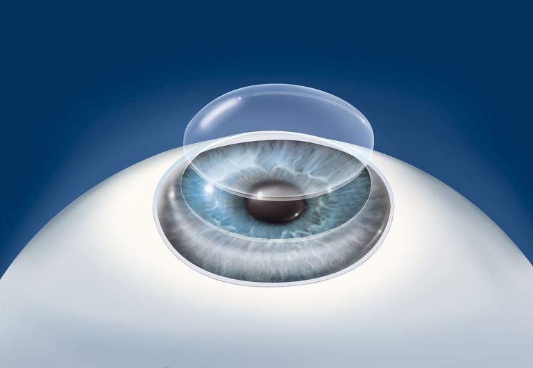 trapianto cornea, della cornea, intervento chirurgico, dell occhio, maggior parte, procedura cheratoplastica