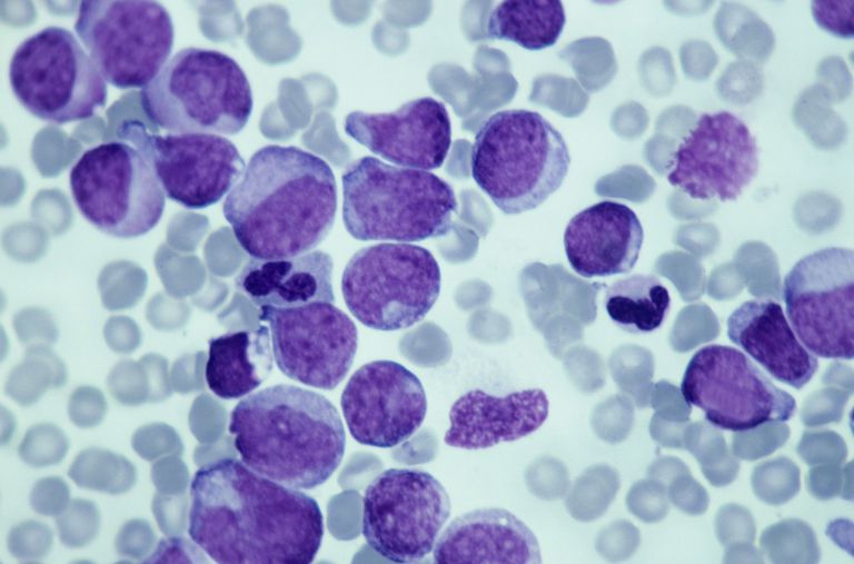 globuli bianchi, delle cellule, cellule sangue, delle cellule sangue, cellule tumorali, moltiplicano senza