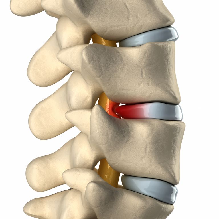 canale centrale, stenosi canale, stenosi canale centrale, midollo spinale, canale spinale