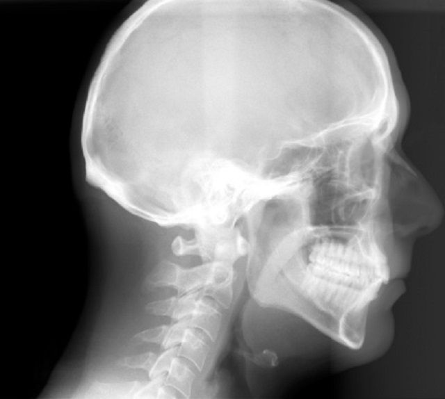 radiografia cefalometrica, trattamento ortodontico, radiografia panorex, viene anche