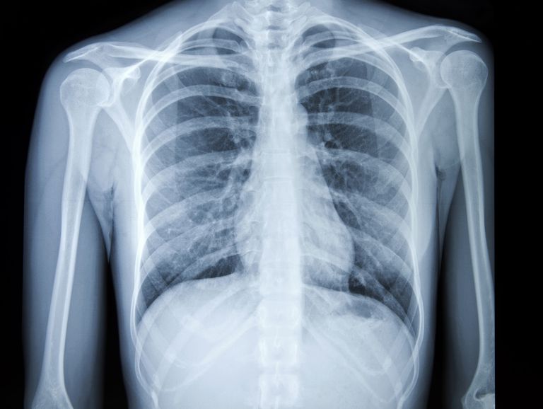 cancro polmone, cancro polmoni, radiografia torace, radiografie torace, fattori rischio, tumori polmonari