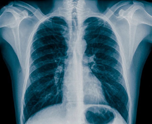 radiografia torace, alle radiazioni, esposizione alle, esposizione alle radiazioni, torace radiografia, altre condizioni