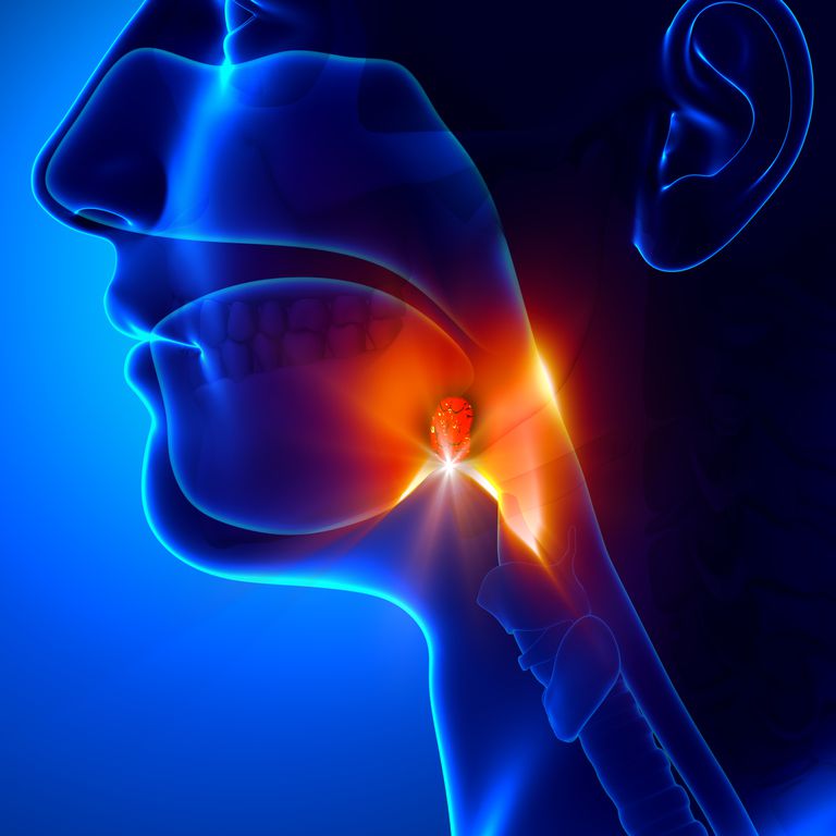 tonsillite cronica, tonsillite ricorrente, della tonsillite, negli adulti