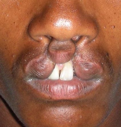 labbro leporino, labbro superiore, della narice, labbro leporino bilaterale, leporino bilaterale