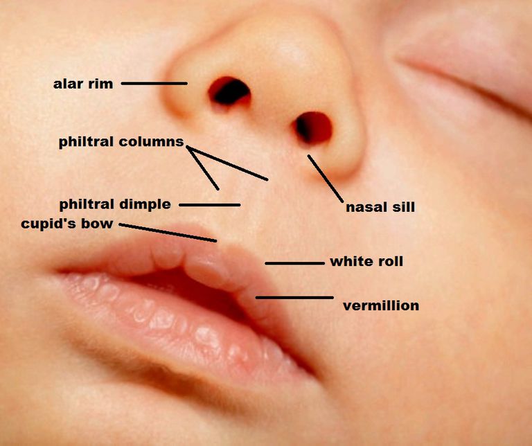 labbro leporino, labbro superiore, della narice, labbro leporino bilaterale, leporino bilaterale