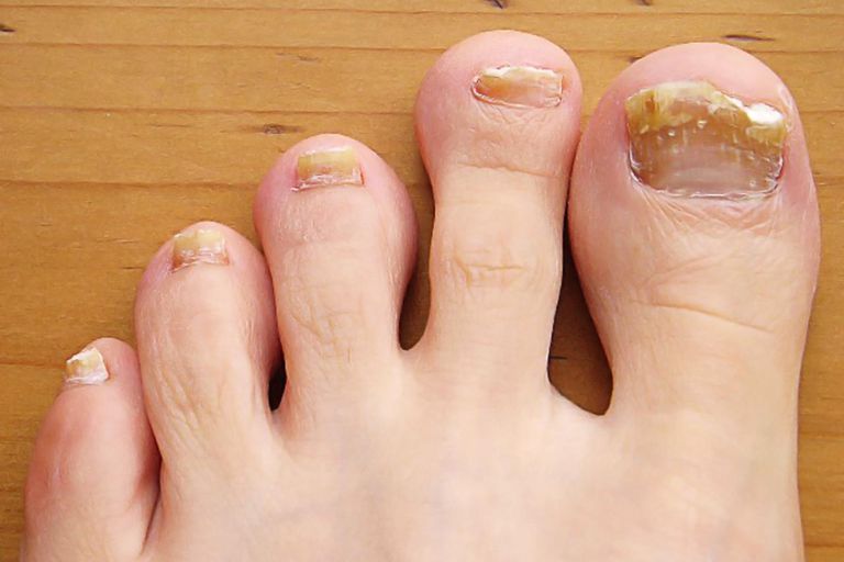 dell unghia, unghia piede, dell unghia piede, delle unghie, infezioni fungine, sotto unghia