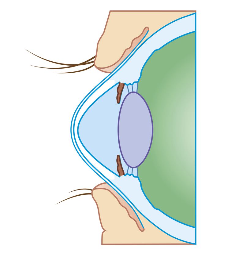 della cornea, crociato corneale, collegamento crociato, collegamento crociato corneale