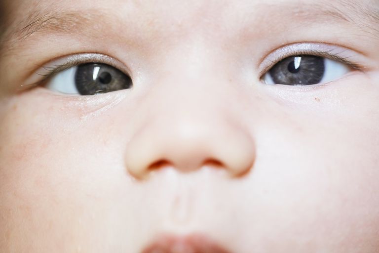 normale occhi, occhi incrociati, degli occhi, dello strabismo, muscoli oculari, occhi bambino