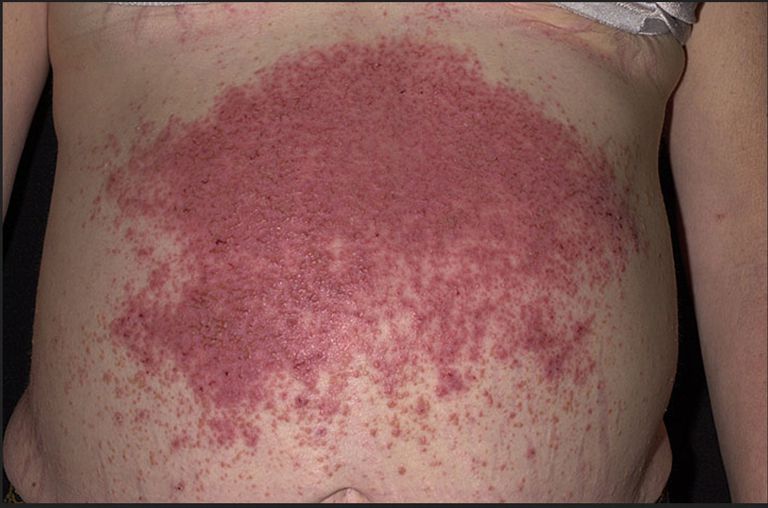 dermatite erpetiforme, della pelle, eruzione cutanea, condizione della, condizione della pelle, erpetiforme sulle