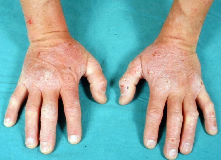 dermatite erpetiforme, della pelle, eruzione cutanea, condizione della, condizione della pelle, erpetiforme sulle