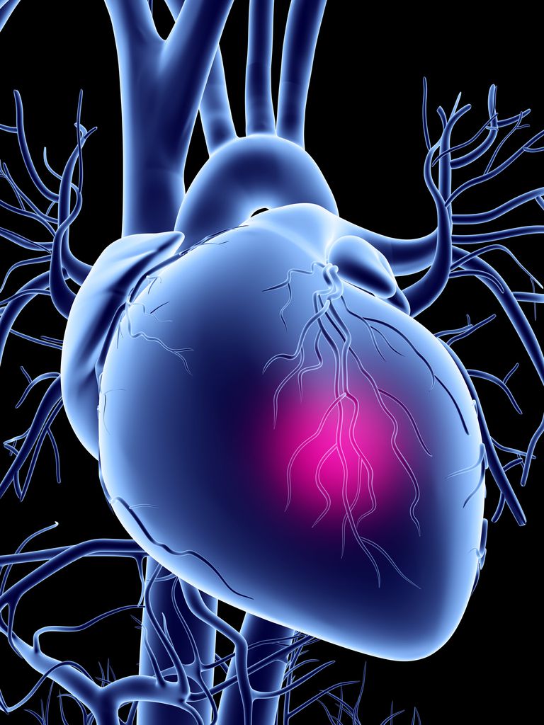 arterie coronarie, cateterizzazione cardiaca, delle arterie, blocchi significativi, depositi calcio, muscolo cardiaco