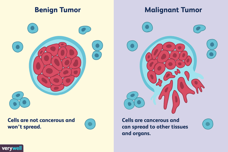 tumori benigni, tumori maligni, tumore benigno, maligni possono, tumori maligni possono, cancro seno