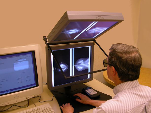 mammografia digitale, mammografia cinematografica, Cancer Institute, digitale stereo