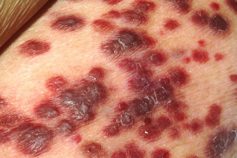 sarcoma Kaposi, sulla pelle, aree simili, aree simili lividi, dolore toracico, dolorose pruriginose
