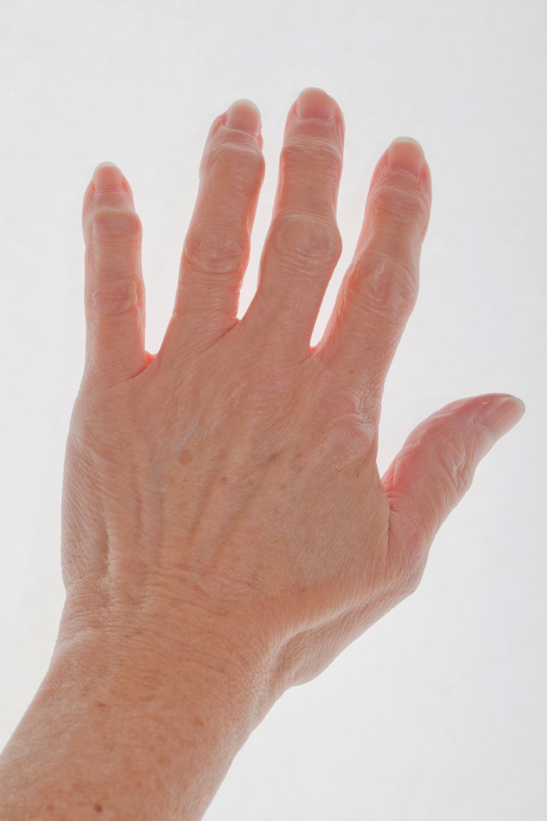 delle dita, dell articolazione, alle articolazioni, artrite delle dita, artrite delle, possono essere