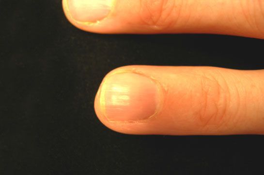 dopo infortunio, punta dito, aspetto normale, della mano, della punta, delle dita