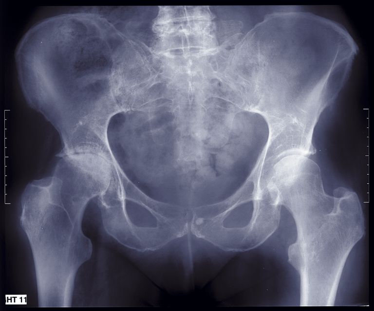 retto femorale, dell anca, della coscia, flessori dell