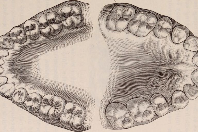 denti giudizio, nella mascella, mascella superiore, molari denti