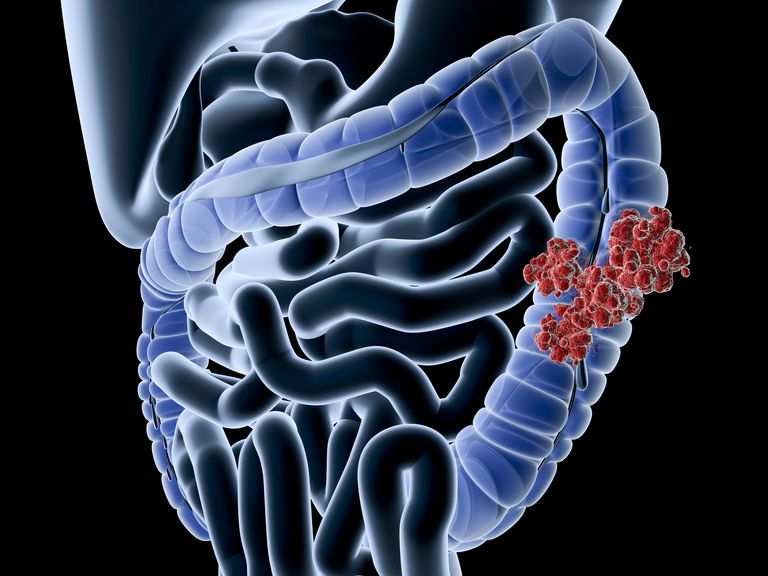 colite Crohn, della colite, intestino tenue, malattia Crohn, rischio cancro