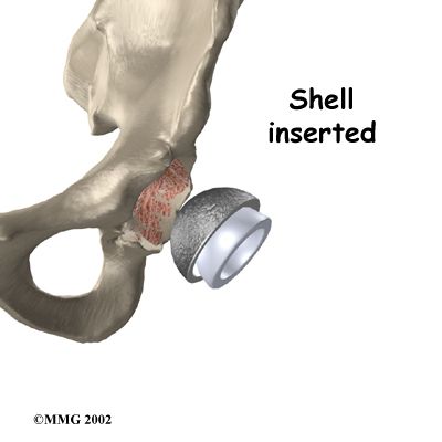 dell anca, sostituzione dell, sostituzione dell anca, articolazione dell, articolazione dell anca, dell articolazione