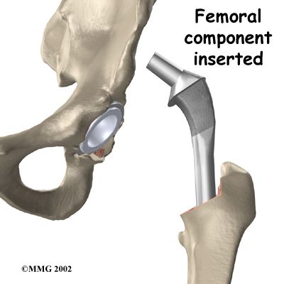 dell anca, sostituzione dell, sostituzione dell anca, articolazione dell, articolazione dell anca, dell articolazione