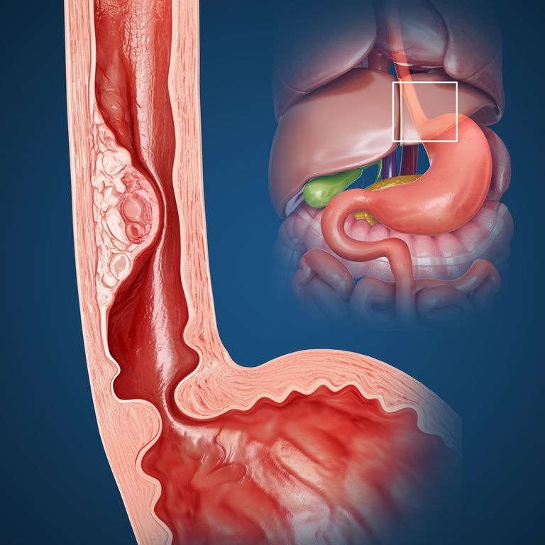 dilatazione esofagea, nell esofago, questa procedura, viene inserito, della dilatazione
