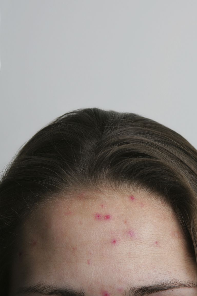 dell acne, causano acne, ghiandole sebacee, maggior parte, ormoni sono, tuoi ormoni