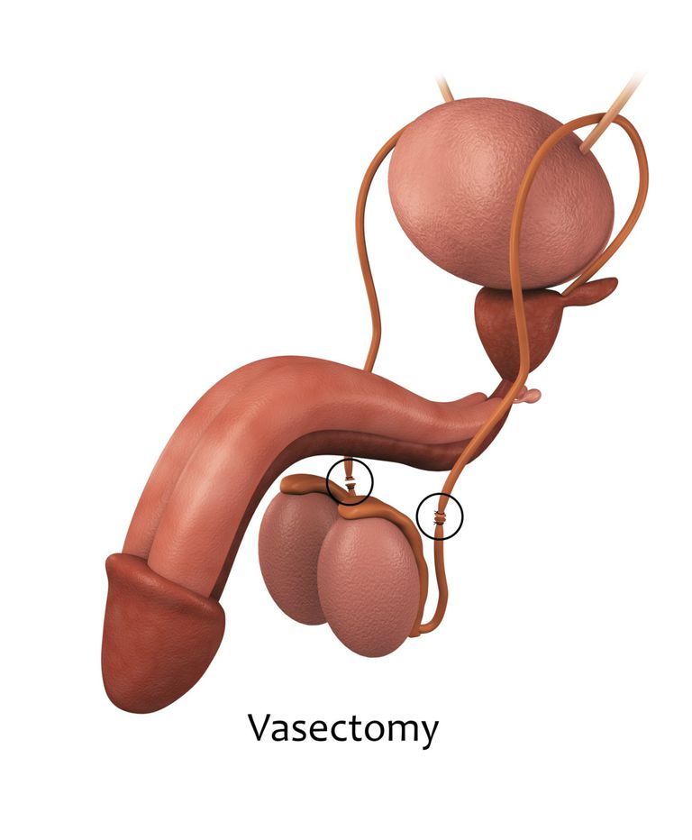 primi mesi, della vasectomia, delle nascite, dopo procedura, dotto deferente