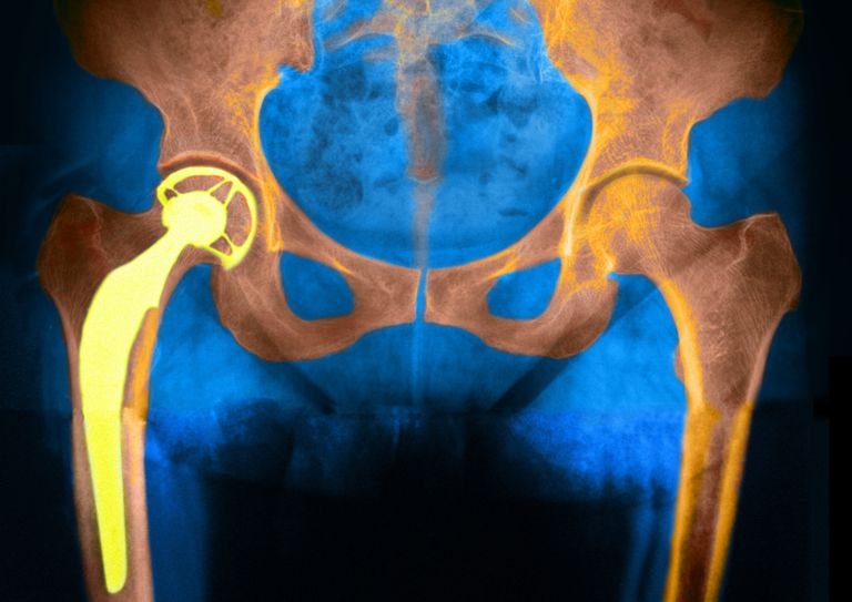 dell anca, sostituzione dell, protesi anca, sostituzione dell anca, dell articolazione