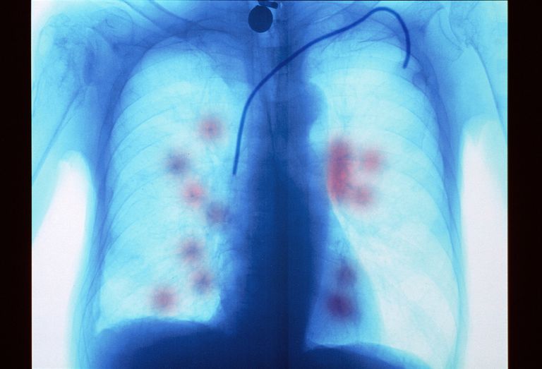 metastasi polmonari, cancro metastatico, metastatico polmoni, cancro metastatico polmoni, cellule tumorali