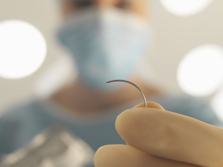 suture assorbibili, assorbibili sono, della incisione, delle suture, suture assorbibili sono, dell incisione